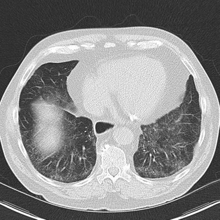 Pulmonary fibrosis - NSIP pattern | Radiology Case | Radiopaedia.org