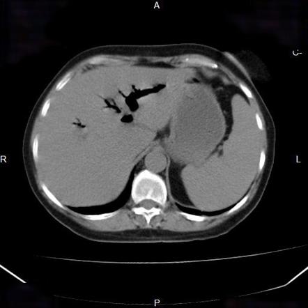 Portal Venous Gas | Radiology Reference Article | Radiopaedia.org