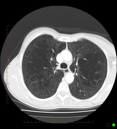 Emphysema Radiology