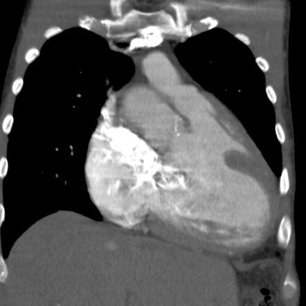 Eisenmenger syndrome in transposition of the great arteries with cor ...