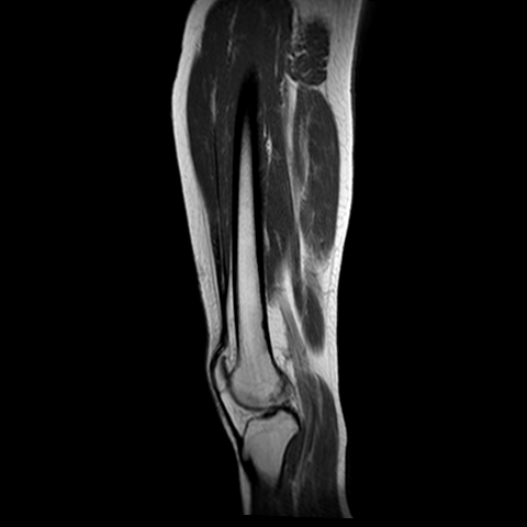 Multiple fibrous cortical defects/non-ossifying fibroma | Image ...