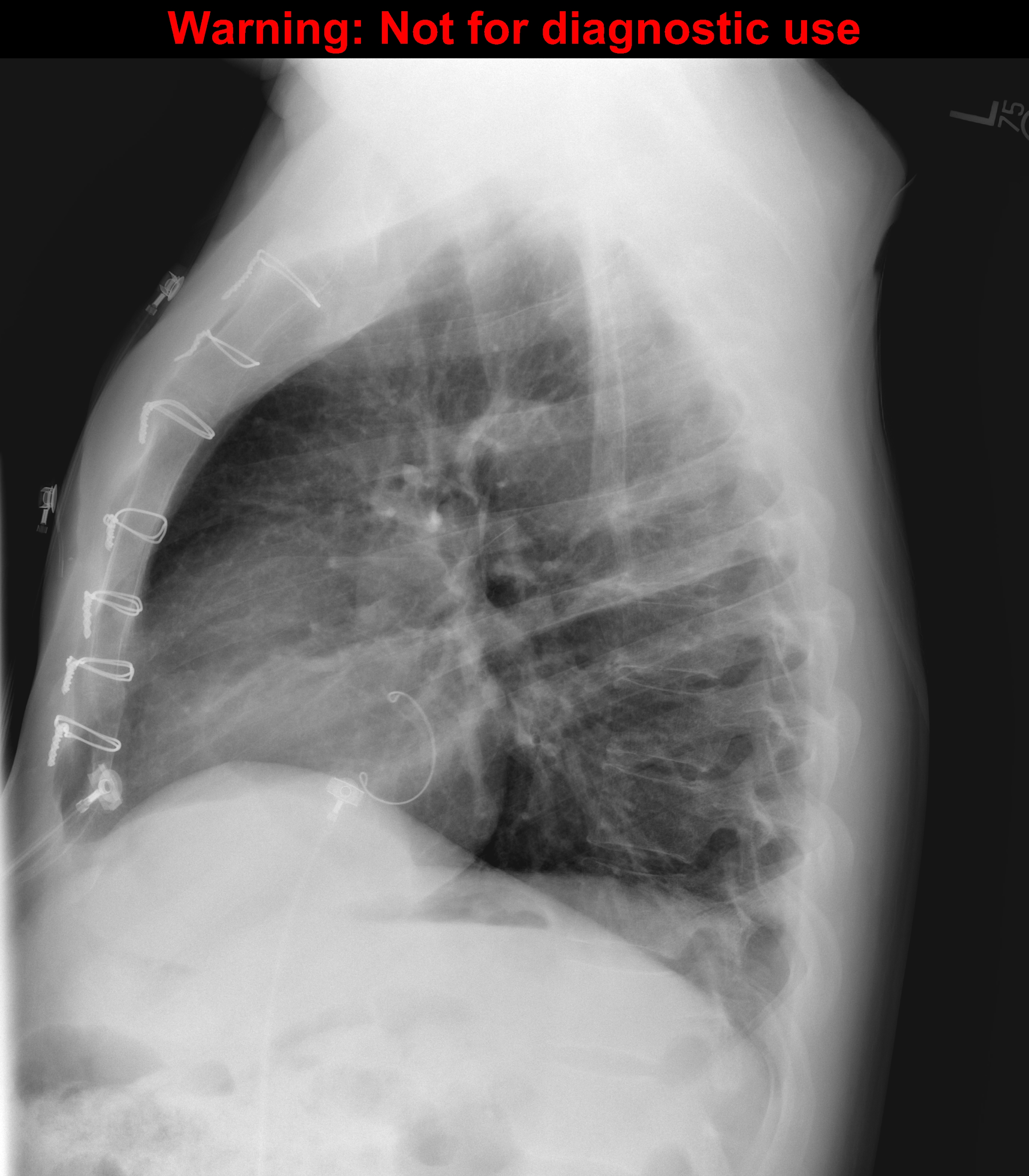 Concomitant Tricuspid Repair in Patients with Degenerative Mitral  Regurgitation | New England Journal of Medicine