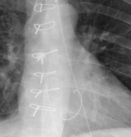 Mitral valve repair | Radiology Reference Article | Radiopaedia.org