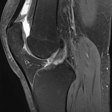 Suprapatellar plica syndrome | Radiology Case | Radiopaedia.org