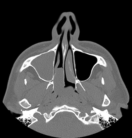 Sinonasal polyposis | Radiology Reference Article | Radiopaedia.org