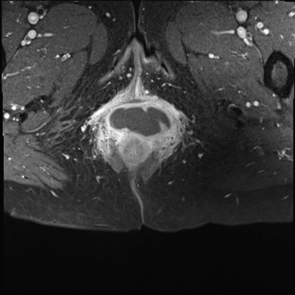 Perineal abscess | Image | Radiopaedia.org