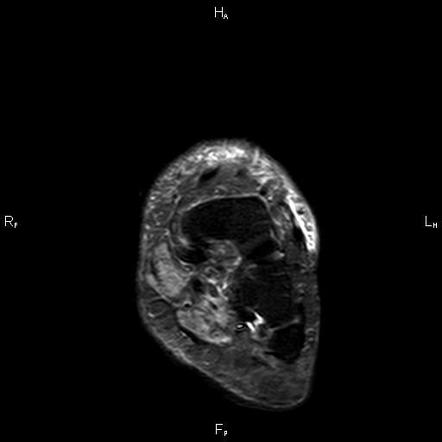 Achilles tendon rupture | Image | Radiopaedia.org