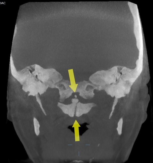 Fusion anomaly of C1 - anterior arch | Radiology Case 