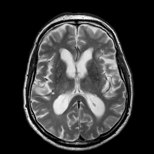 Creutzfeldt-Jakob disease (CJD) | Image | Radiopaedia.org