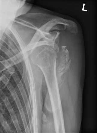 Old unreduced anterior dislocation of shoulder with fracture of the ...