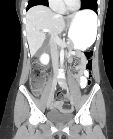 Perforated duodenal ulcer | Image | Radiopaedia.org