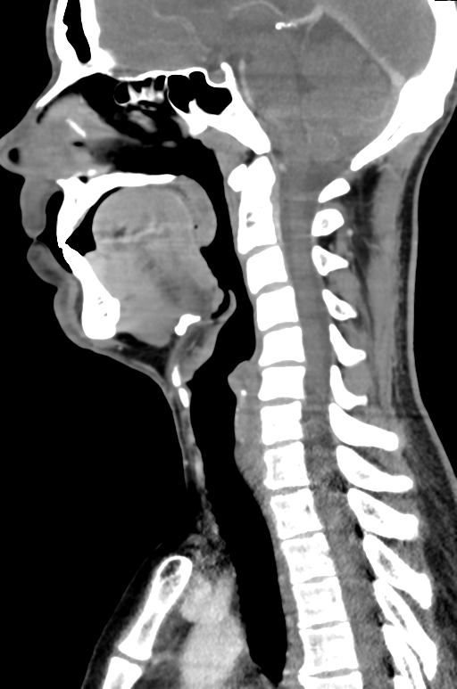 Odontogenic Keratocyst Image