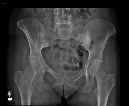 Sacroiliac Enteropathic Arthropathy 