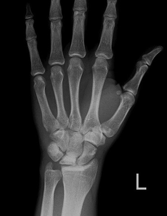 Negative ulnar variance | Radiology Reference Article | Radiopaedia.org