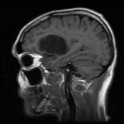 Diffuse Astrocytoma Idh Mutant Image