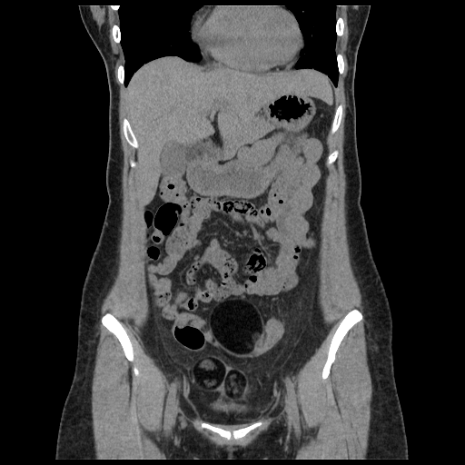 Bilateral Mature Cystic Teratomas Image 0687