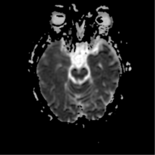 Limbic encephalitis | Image | Radiopaedia.org