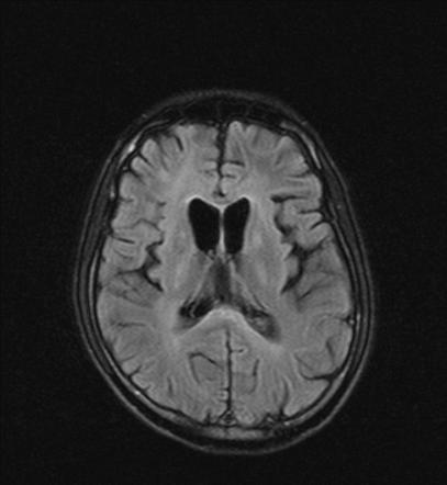 Cytotoxic lesions of the corpus callosum (CLOCCs) | Radiology Reference ...