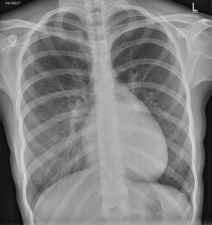 Williams syndrome | Radiology Reference Article | Radiopaedia.org