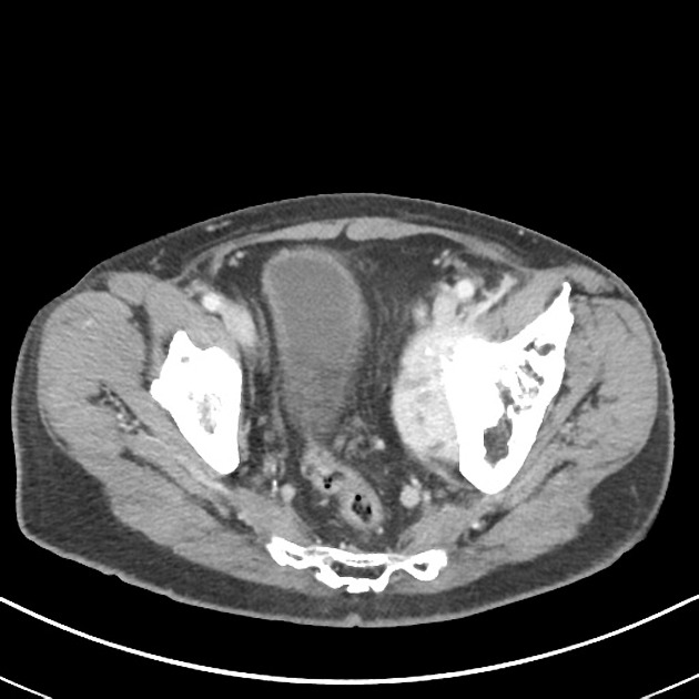 Secondary osteosarcoma | Radiology Reference Article | Radiopaedia.org