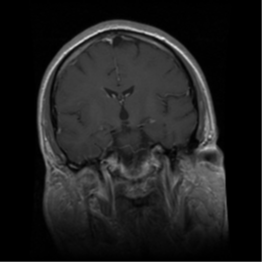 Limbic Encephalitis Image