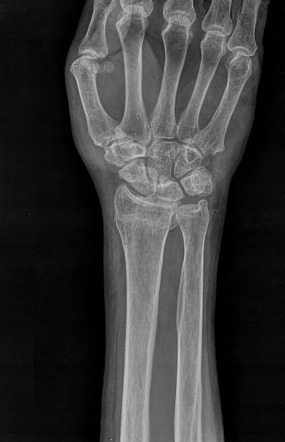 colles fracture right wrist icd 10