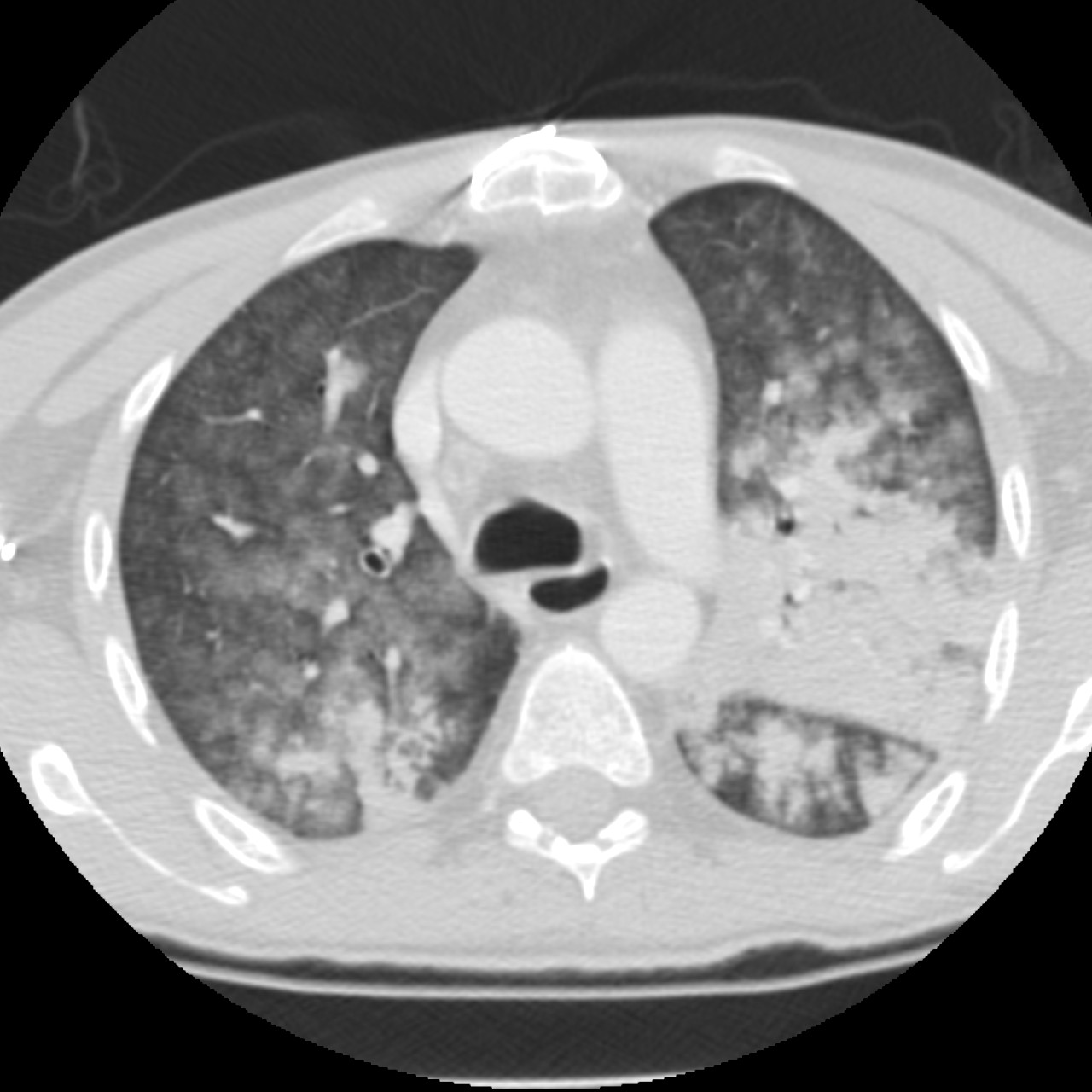 Acute diffuse alveolar hemorrhage | Image | Radiopaedia.org