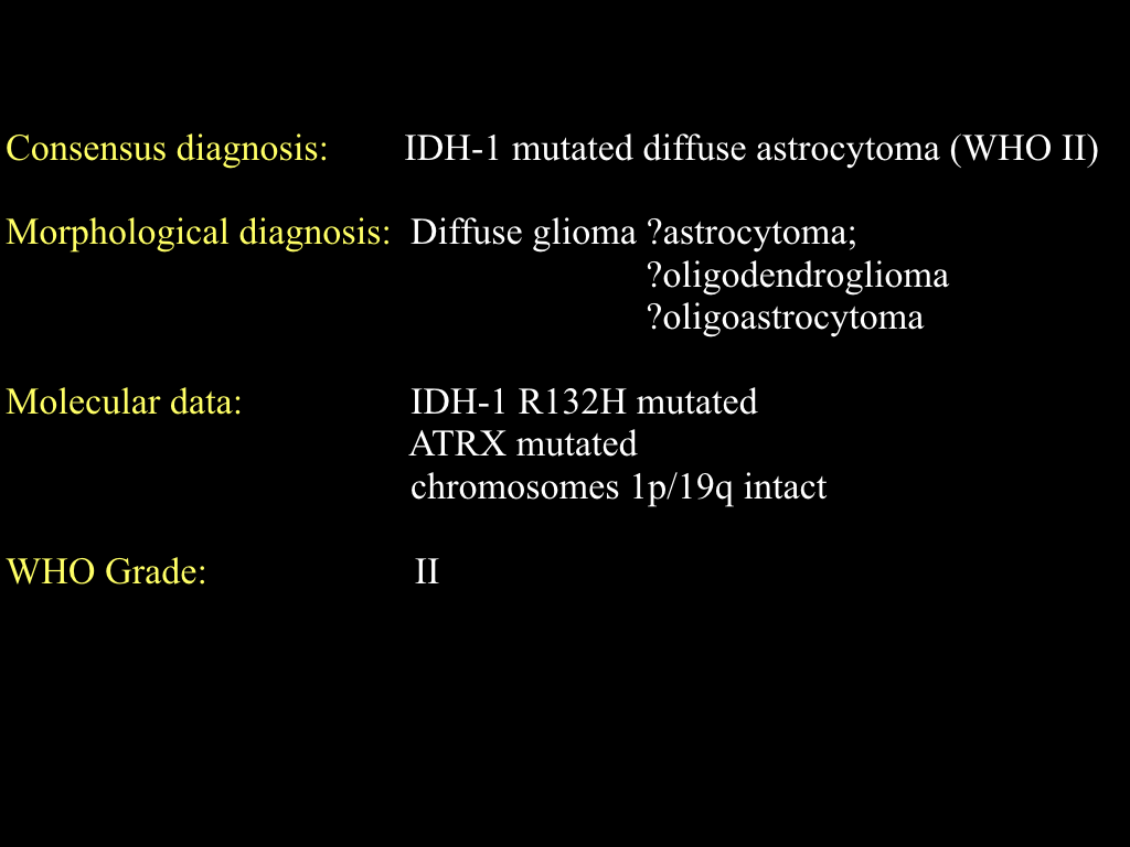 Diffuse Astrocytoma Idh Mutant Image