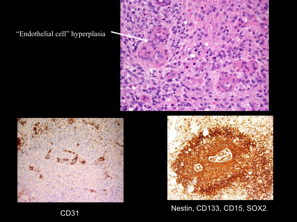 Glioblastoma Idh Wild Type Image