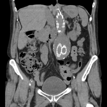 Abdominal aortic stent graft | Radiology Case | Radiopaedia.org