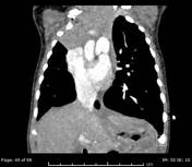 Viewing playlist: Chest Viva | Radiopaedia.org