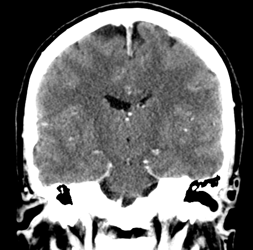 Idiopathic Intracranial Hypertension Image 6020