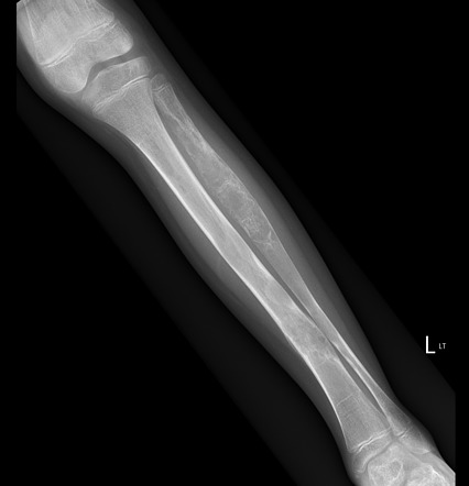 Polyostotic fibrous dysplasia | Radiology Case | Radiopaedia.org