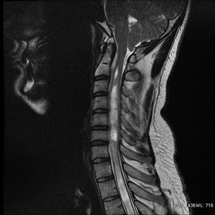 Chiari I malformation | Radiology Reference Article | Radiopaedia.org