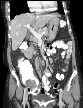 Adenocarcinoma of the colon | Radiology Case | Radiopaedia.org