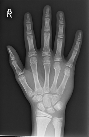 Boxer fracture | Radiology Case | Radiopaedia.org