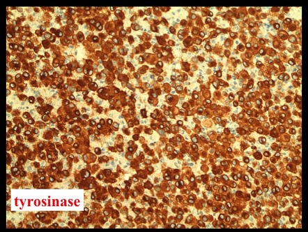 Metastatic malignant melanoma | Image | Radiopaedia.org