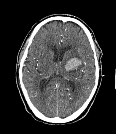 Striatocapsular hemorrhage and fenestrated basilar artery | Image ...