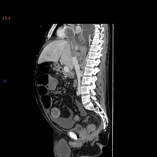 Intracardiac tumor thrombi | Image | Radiopaedia.org