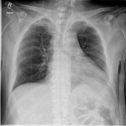 Ventriculoperitoneal shunt migration into the pulmonary artery | Image ...