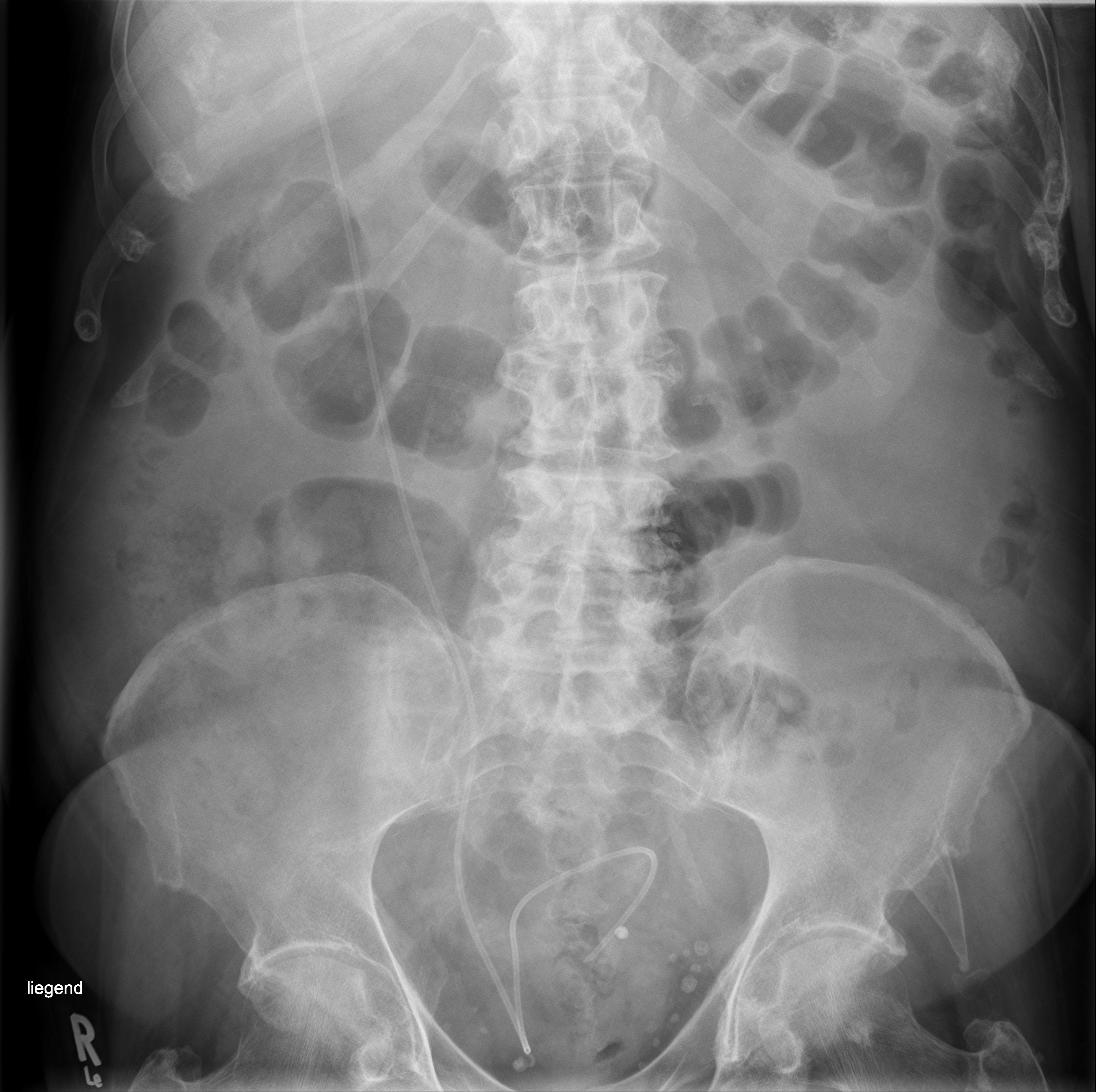 Ventriculoperitoneal shunt migration into the pulmonary artery | Image ...