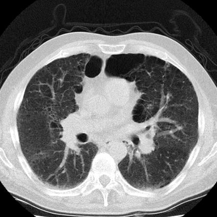 Usual interstitial pneumonia | Radiology Reference Article ...