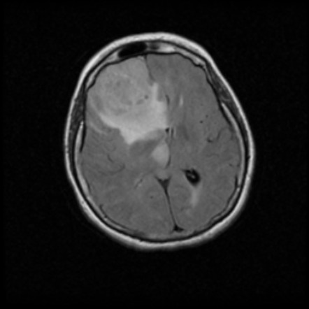 Glioblastoma IDH wild-type | Image | Radiopaedia.org