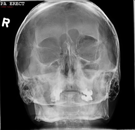 Black eyebrow sign | Radiology Reference Article | Radiopaedia.org