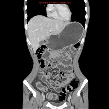 Crohn disease | Radiology Case | Radiopaedia.org