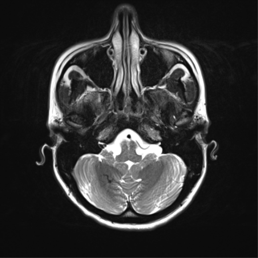 Radiology Quiz 41402 | Radiopaedia.org | Playlist 'MRT Hirn' by Dr 