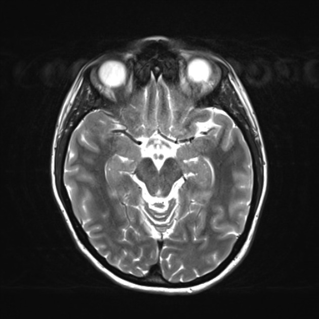 Radiology Quiz 41402 | Radiopaedia.org | Playlist 'MRT Hirn' by Dr 