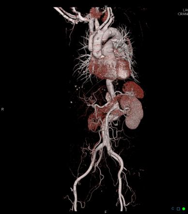 Playlist 'Vascular disorders' by Dr Tom Molyneux