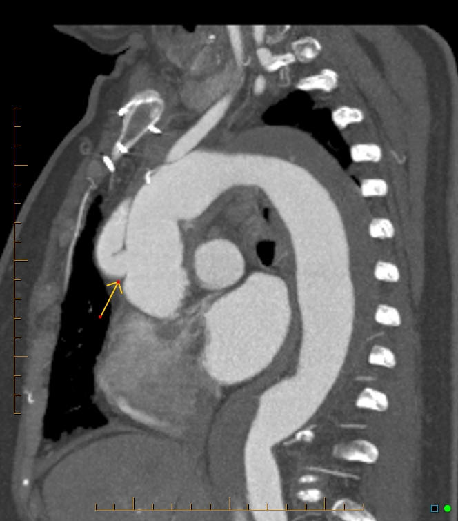 Surgically corrected type A thoracic aortic dissection | Image ...