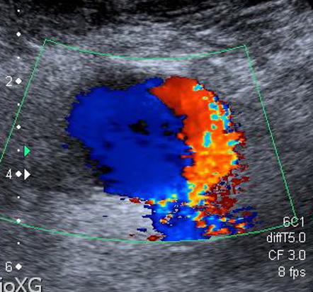 Yin-yang sign (vascular) | Radiology Reference Article